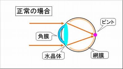 乱視とは 乱視を治すために